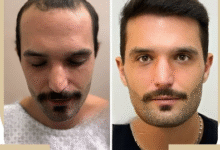 How Long Is Hair Transplant Recovery?