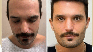 How Long Is Hair Transplant Recovery?