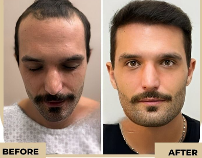 How Long Is Hair Transplant Recovery?